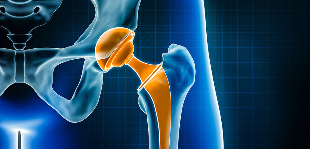 Total Hip Arthroplasty Patients Under 65 Have Low Revision Rates